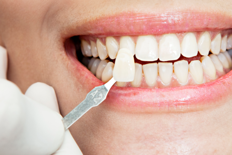 Teeth Whitening at Westheights Dental